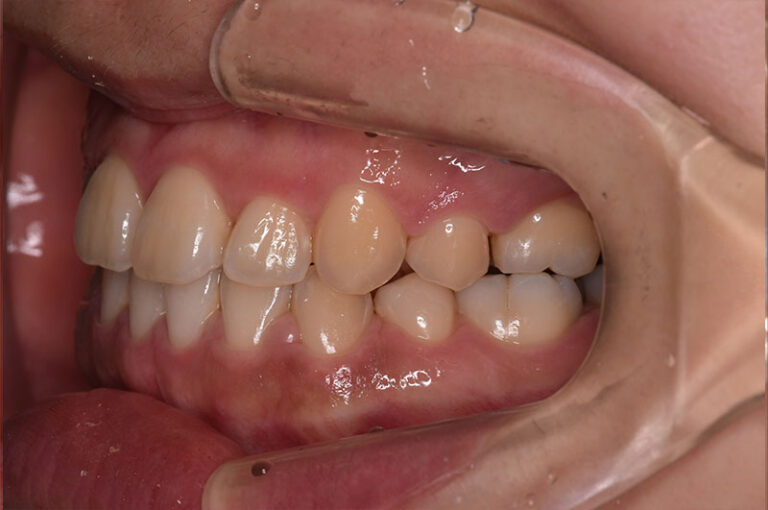 矯正治療により反対咬合が改善した口元を、右側から撮影した写真