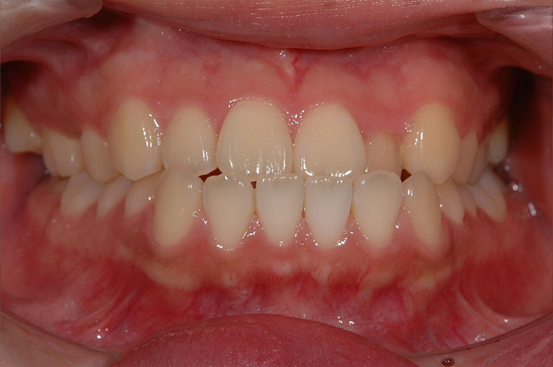 矯正治療前の反対咬合の口元を、正面から撮影した写真