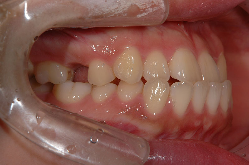 矯正治療前の反対咬合の口元を、左側から撮影した写真