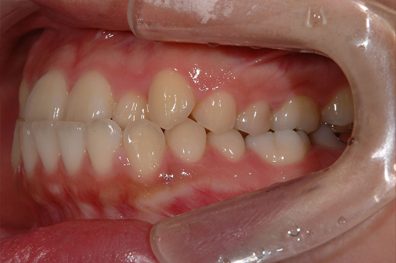 矯正治療前の反対咬合の口元を、右側から撮影した写真