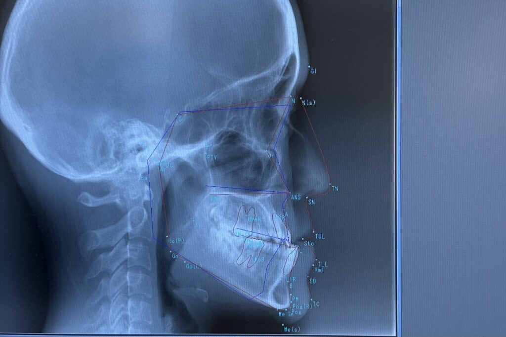 顎の骨や歯の位置関係を確認するために撮影する歯科用レントゲン写真(セファロ)の画像