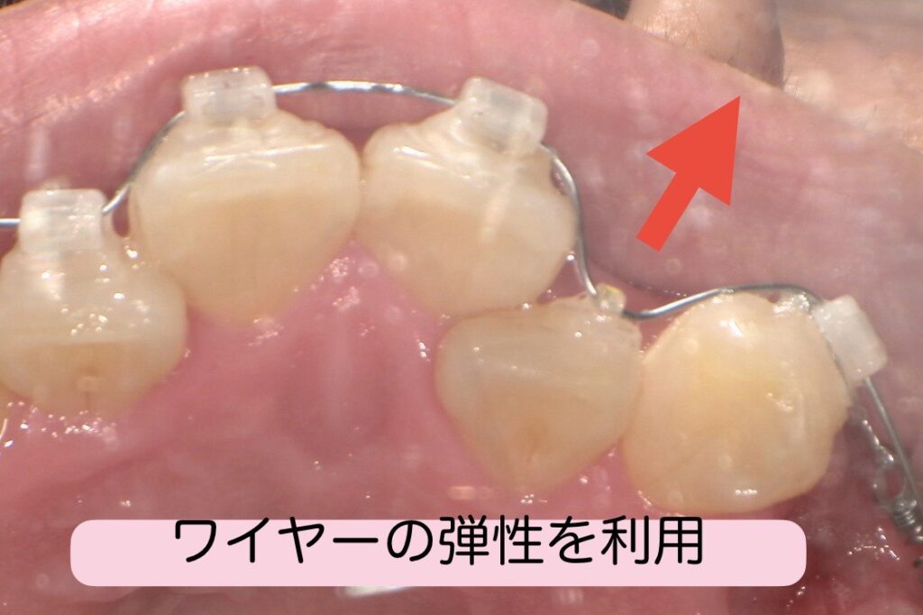 表側マルチブラケット装置で歯が動く仕組み