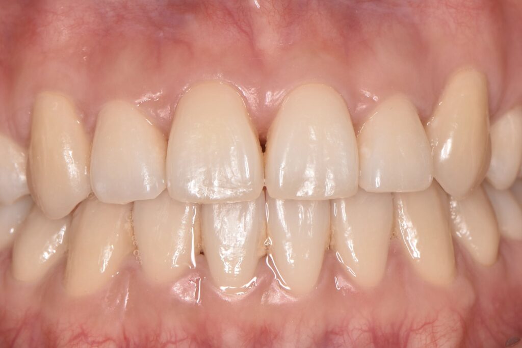 表側マルチブラケット矯正(治療後)