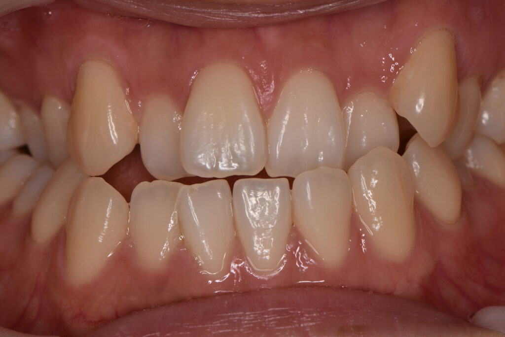 表側マルチブラケット矯正(治療前)