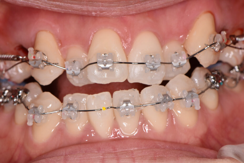 表側マルチブラケット矯正(治療中・前半)