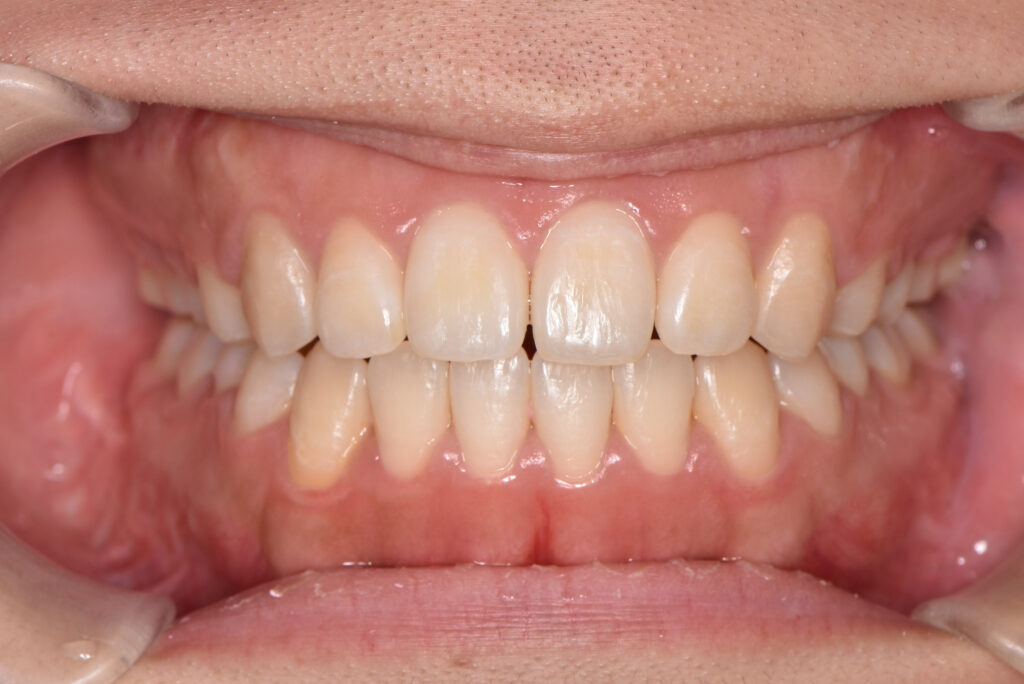 開咬の矯正治療後の口腔内写真。前歯が上下でしっかり噛み合っている状態
