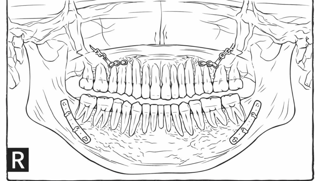 開咬を改善するための方法として、外科的手術によって顎の骨にプレートを固定したことを表すレントゲンのイラスト