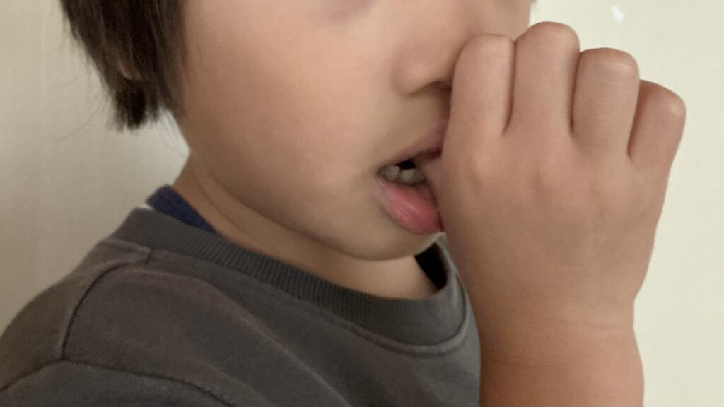 指しゃぶりによって前歯が前方に押され、開咬の原因となる可能性を示した画像