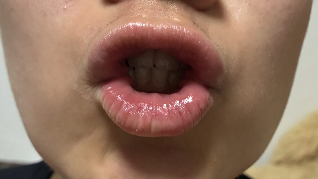 「あいうべ体操」の「う」の画像