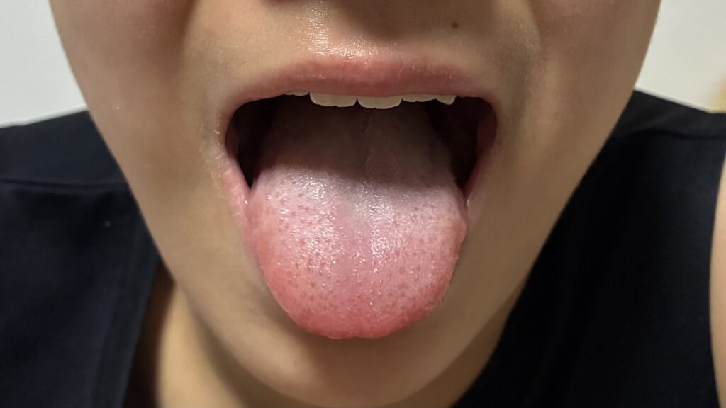 「あいうべ体操」の「べ」の画像