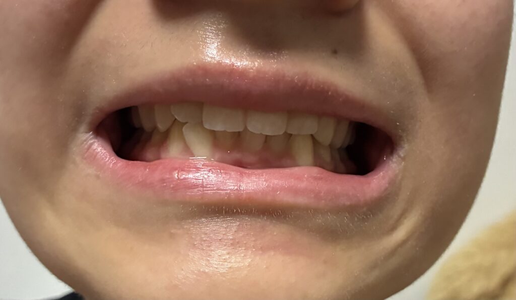 「あいうべ体操」の「い」の画像