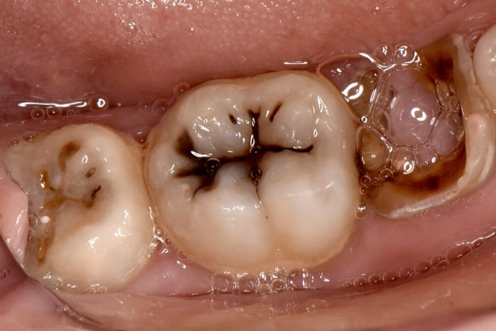 進行したむし歯