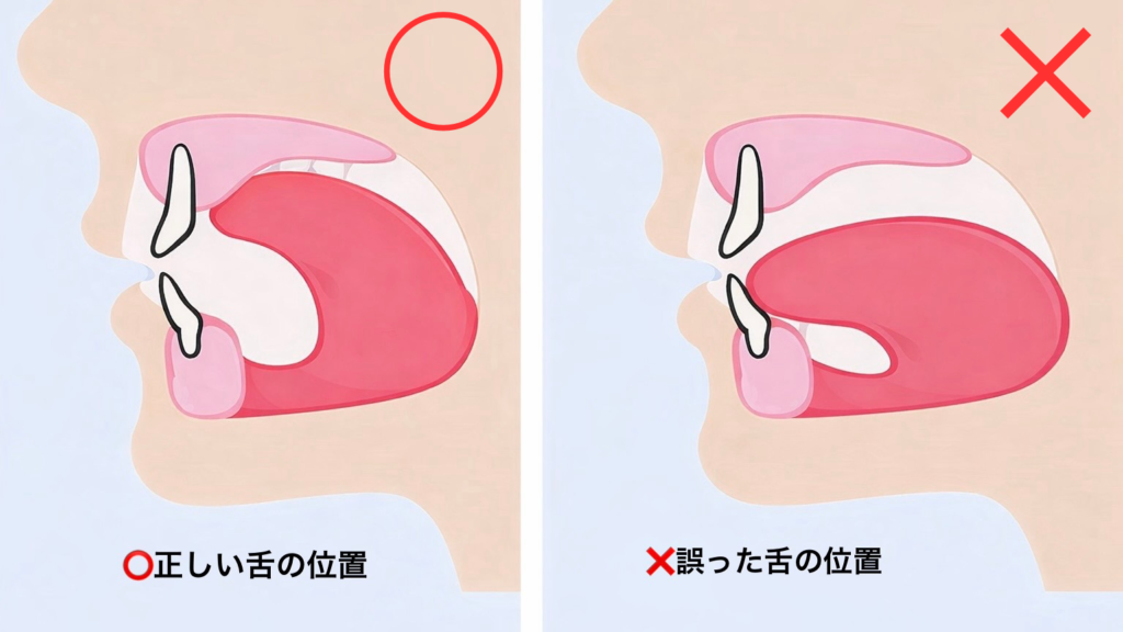 正しい舌の位置・間違った舌の位置の比較
