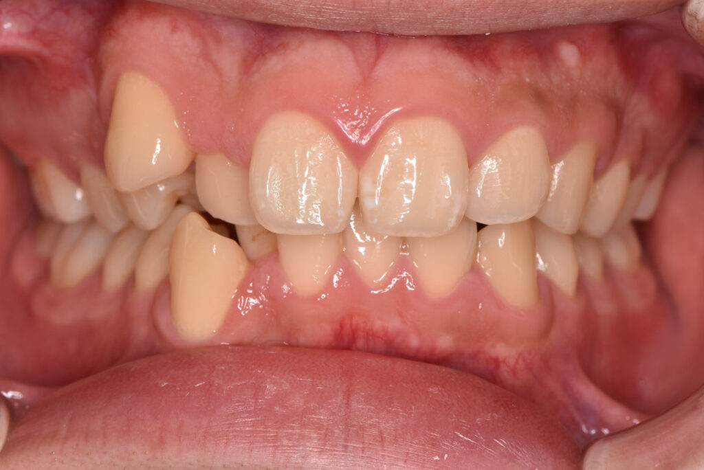 歯がガタガタに並んでいる様子