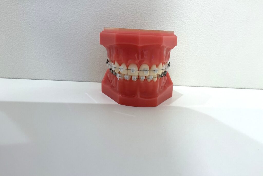 表側ワイヤー矯正の模型