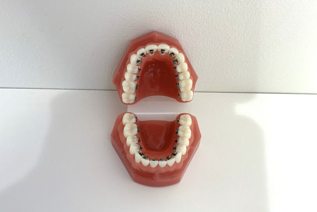 舌側矯正の模型