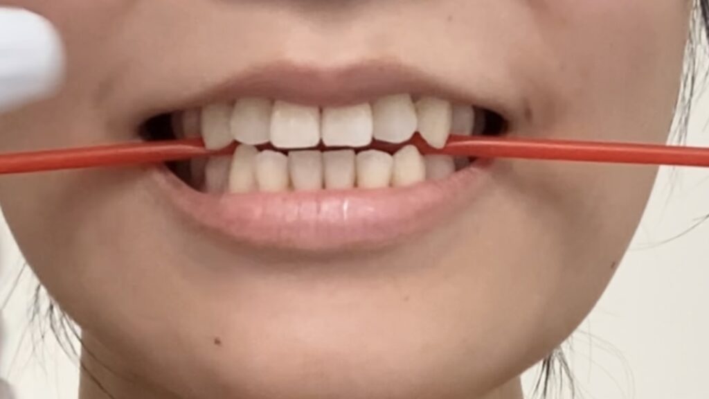 口腔筋機能療法(MFT)の手順を紹介している画像（上下の歯でストローを固定）