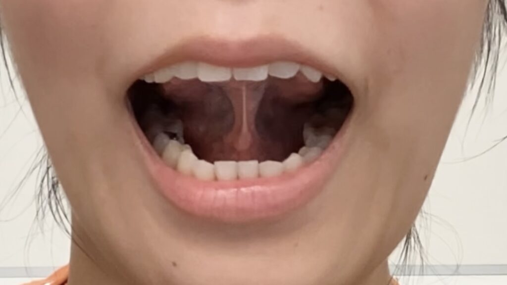 口腔筋機能療法(MFT)の手順を紹介している画像（舌先をスポットにつける）