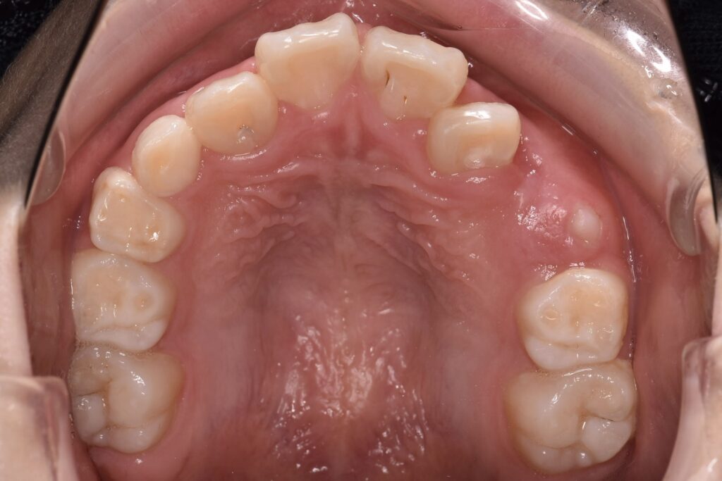 こどもの口腔内写真