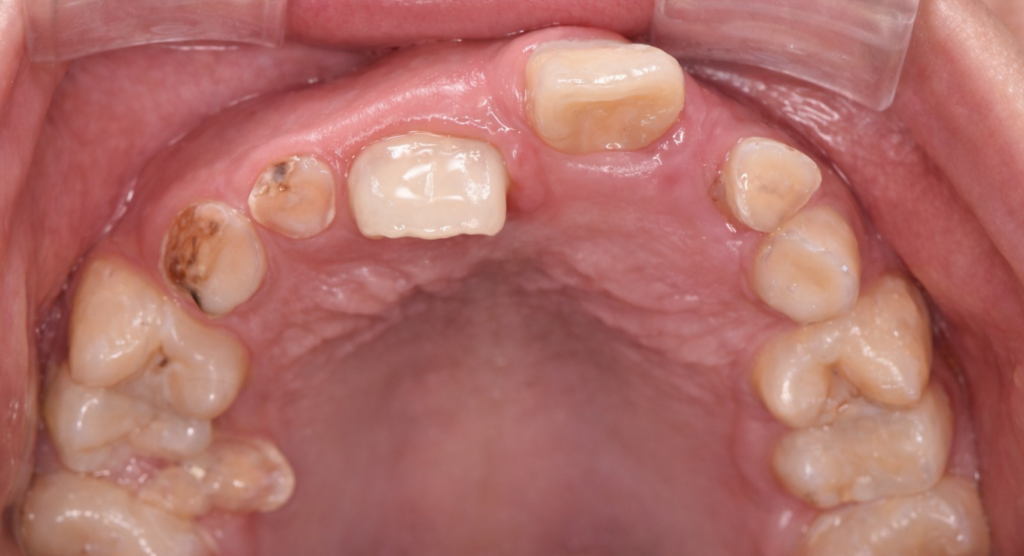 乳歯が抜けるのが早く、歯並びが崩れてしまった様子