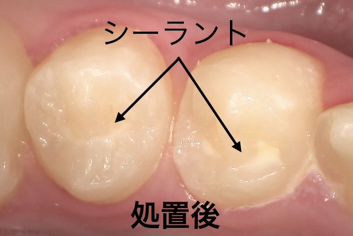 シーラント処置後
