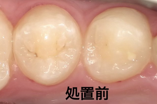 シーラント処置前