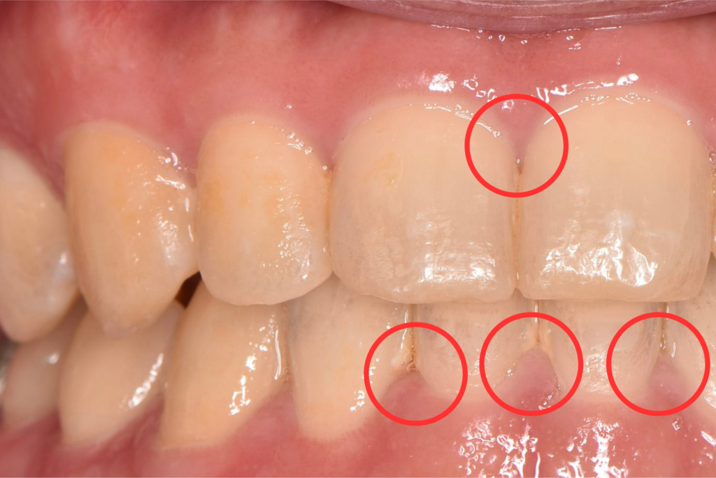 歯ぐきが腫れている様子