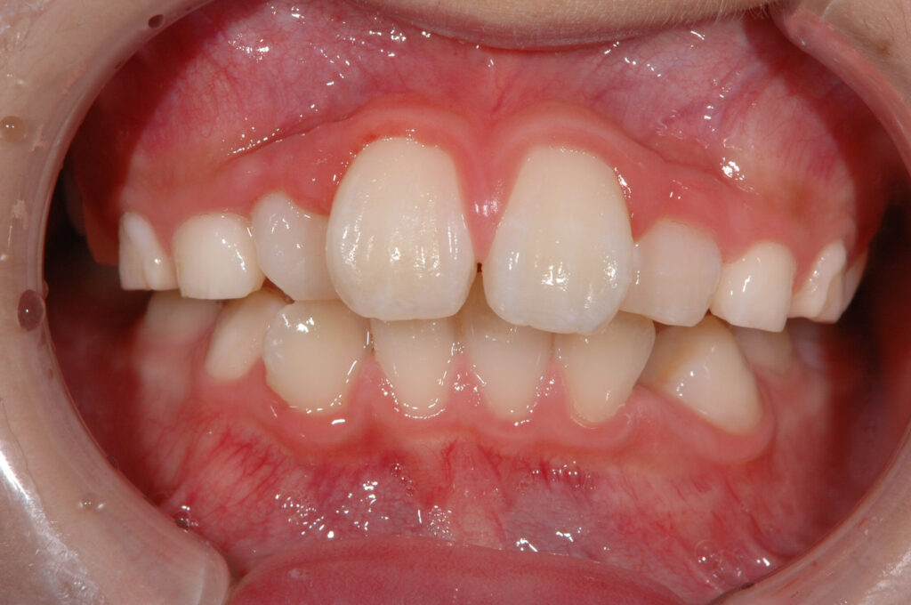 歯が大きいため、並びきらない様子