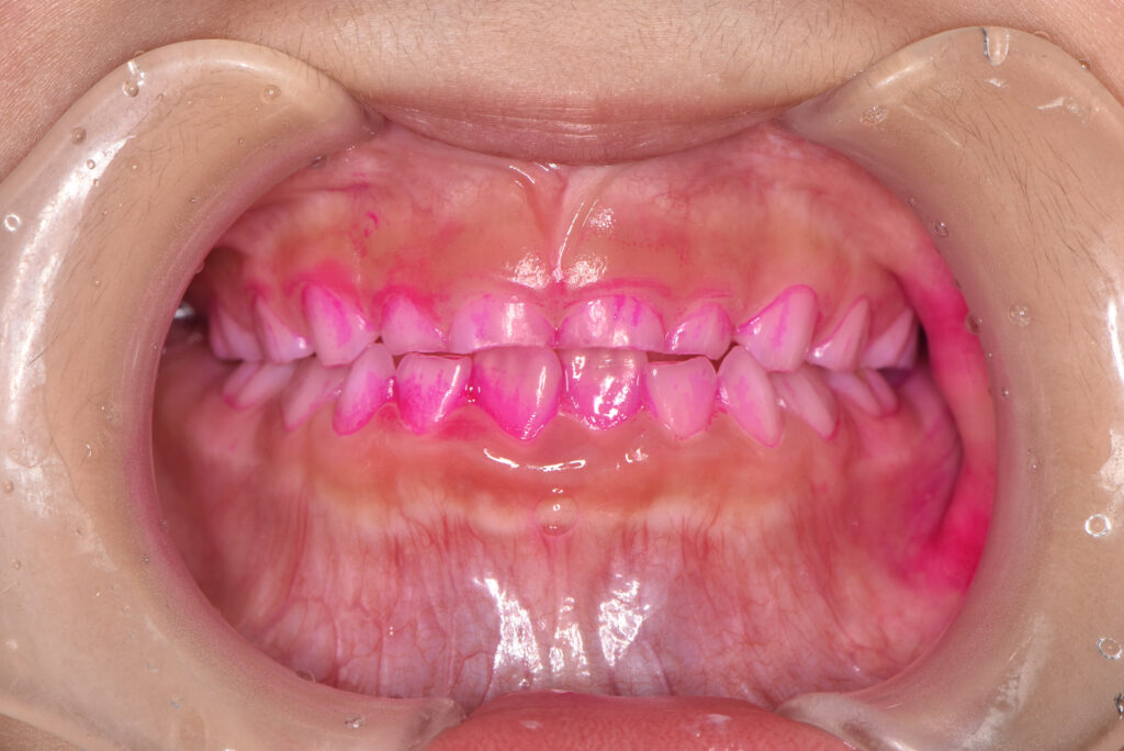 歯の染め出しの画像