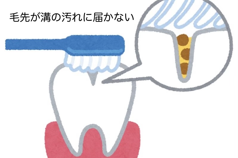 奥歯の溝に歯ブラシの毛先が入らない