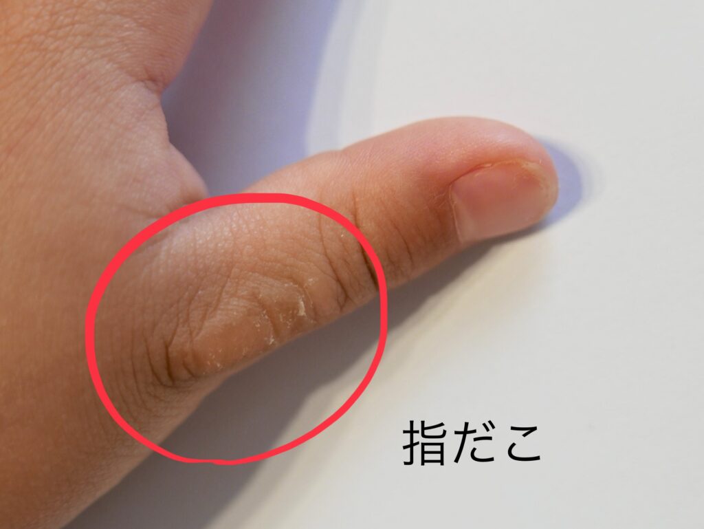 指しゃぶりの習慣によってできることがある指だこの写真