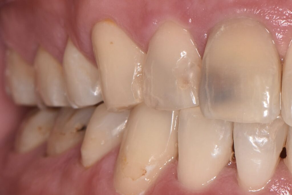 むし歯(歯の表面が変色)