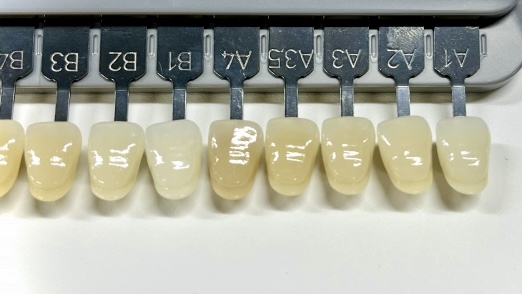 ホワイトニングのシェード