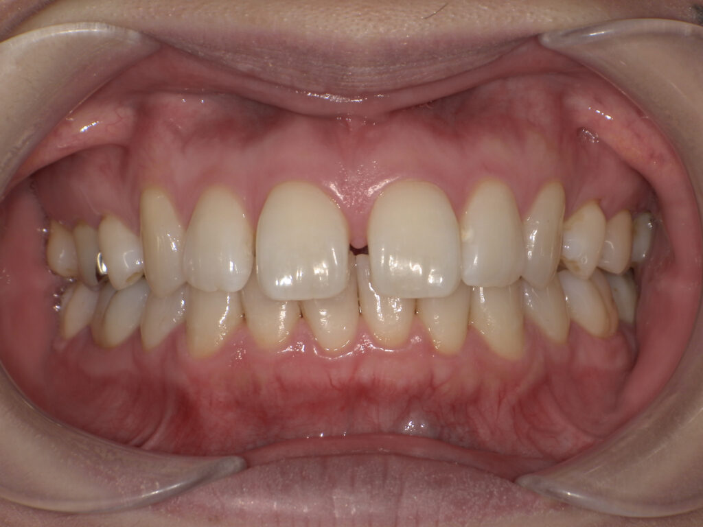 すきっ歯の症例（マウスピース矯正・術前・正面）