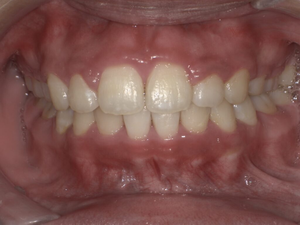 すきっ歯の症例（ワイヤー矯正・術後・正面）