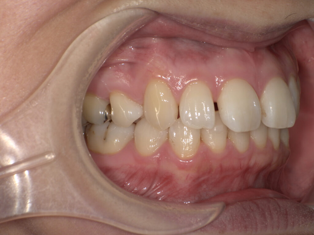 すきっ歯の症例（マウスピース矯正・術前・側貌）