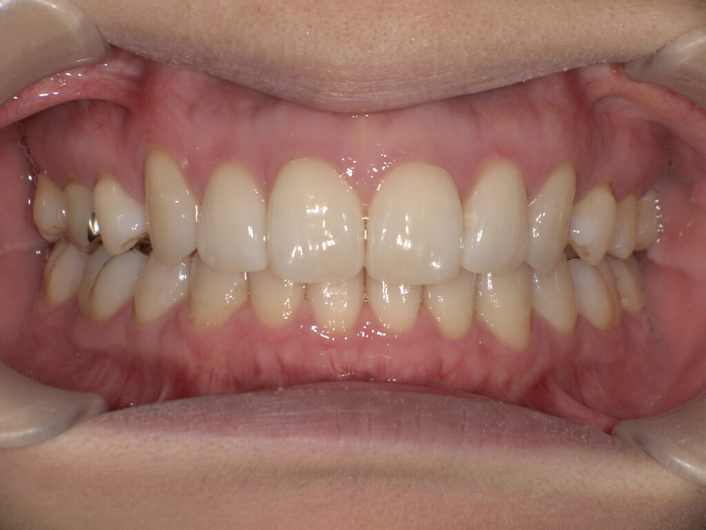 すきっ歯の症例（マウスピース矯正・術後・正面）
