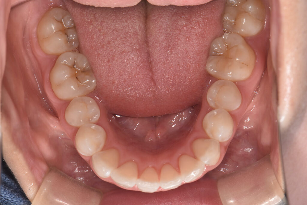 舌クリーニング後