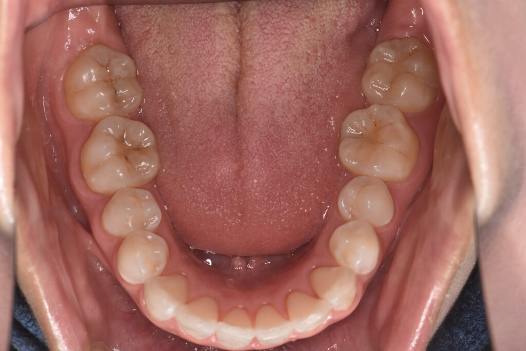 舌クリーニング前