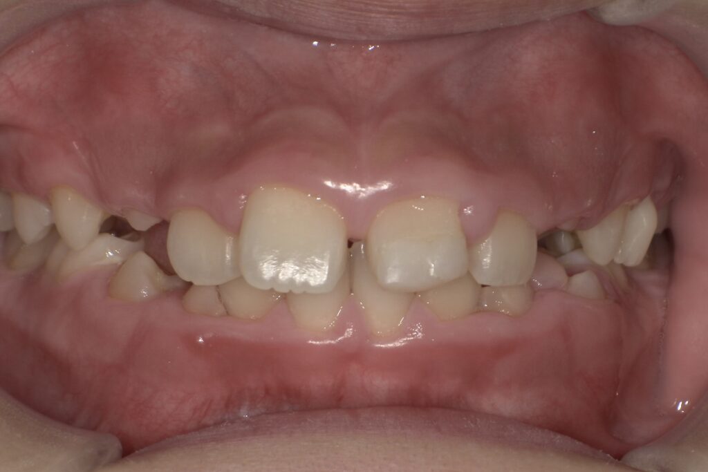 こどものすきっ歯（正中離開）