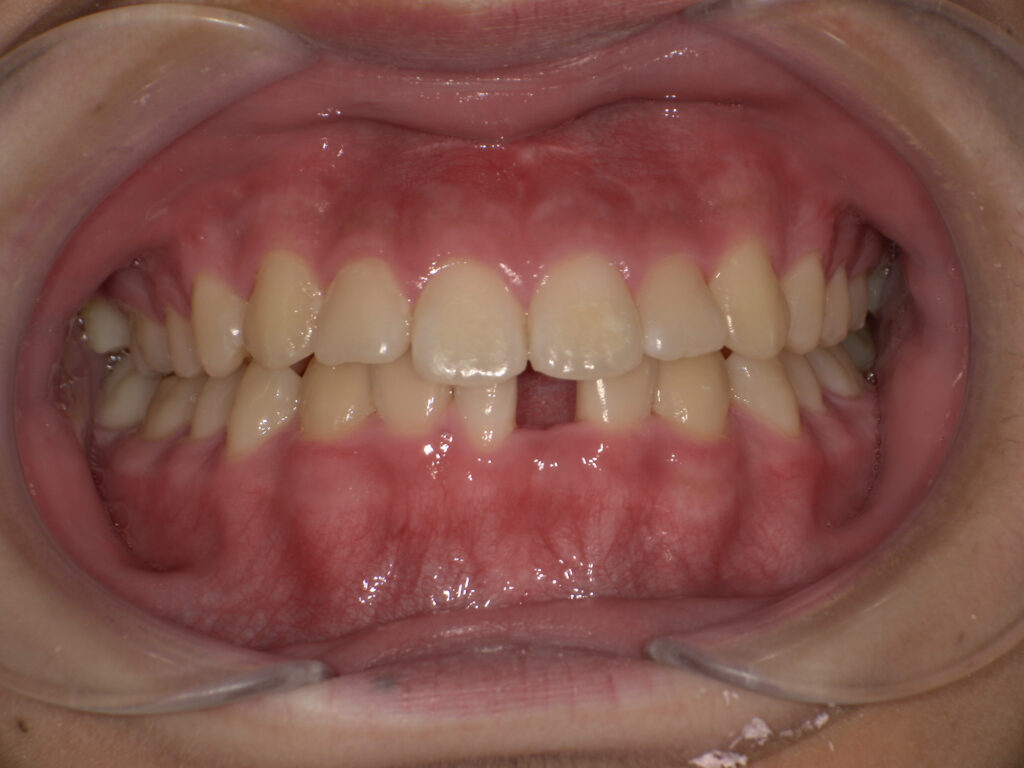 先天的な歯の欠如