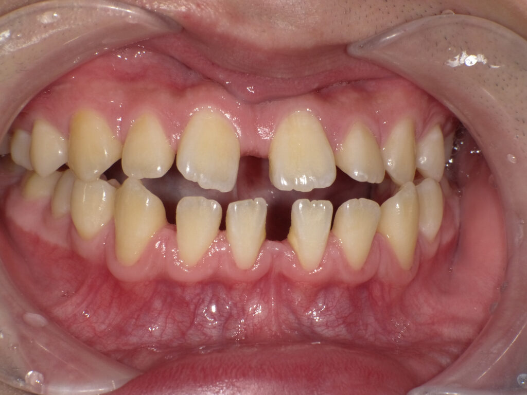 歯列のでこぼこ