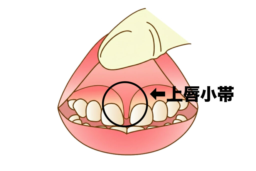 上唇小帯