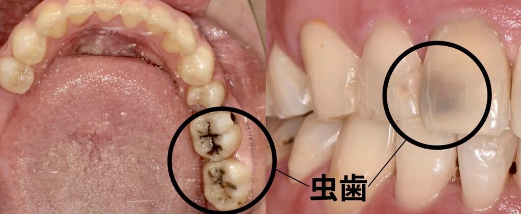 むし歯