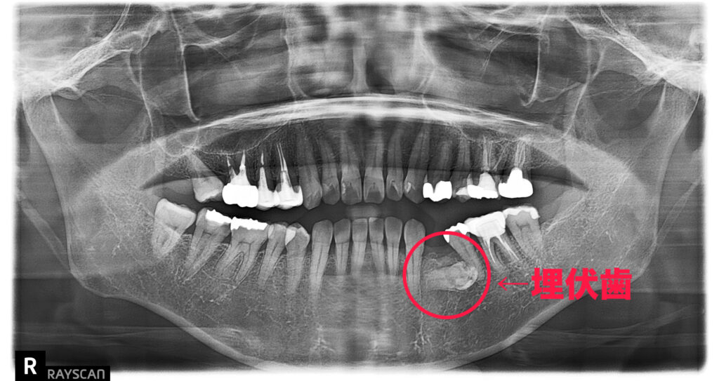 埋伏歯のレントゲン写真（パノラマ）