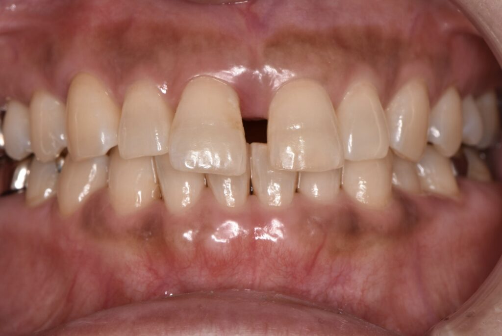 すきっ歯（正中離開）