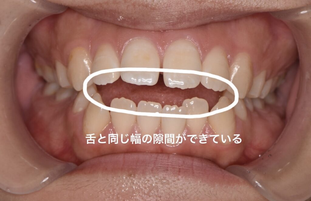 日々のわずかな舌の動きで、歯が動いてしまった様子