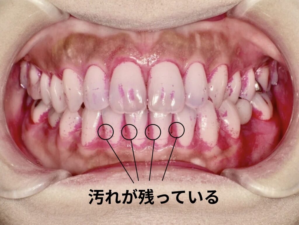 歯磨きで汚れが落とせていない様子
