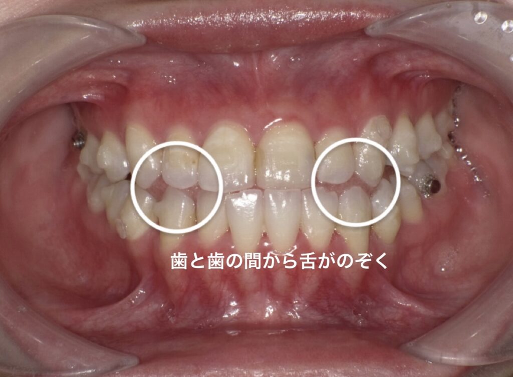 歯と歯の間から舌がのぞいている