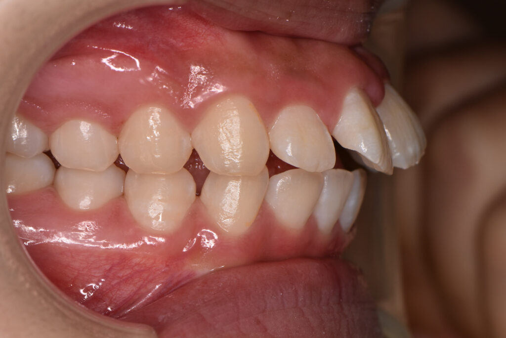 すきっ歯の症例（ワイヤー矯正・術前・側貌）